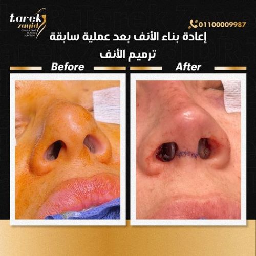 افضل دكتور تجميل انف في مصر 2026